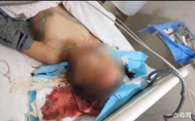 女孩被自家狗撕咬 宠物狗发狂连自家人都咬