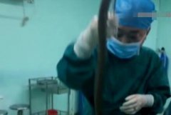 男子腹痛难忍就医,吃惊!体内藏有半米长黄鳝